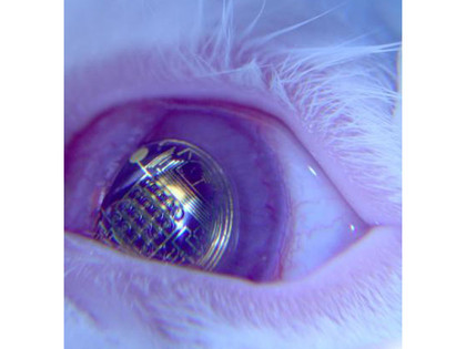 contact lens